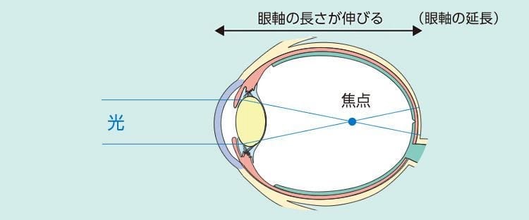 病的近視による脈絡膜新生血管
