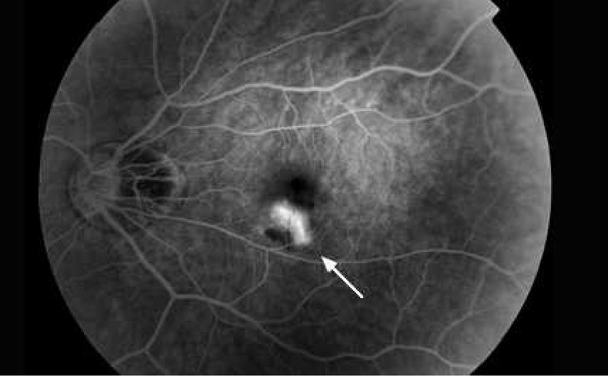 近視性脈絡膜新生血管（脈絡膜新生血管）とは