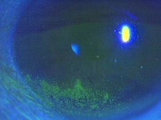 ドライアイのチェック