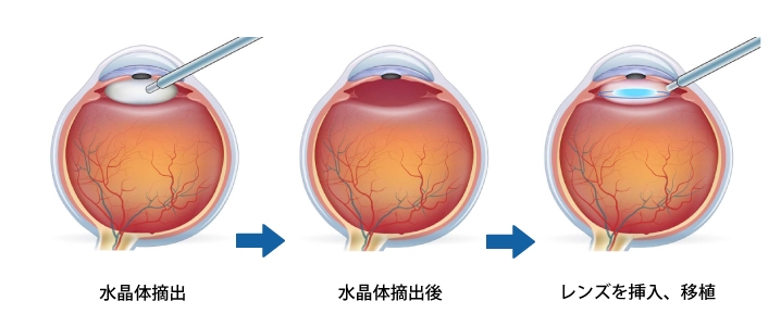 一般的な白内障手術