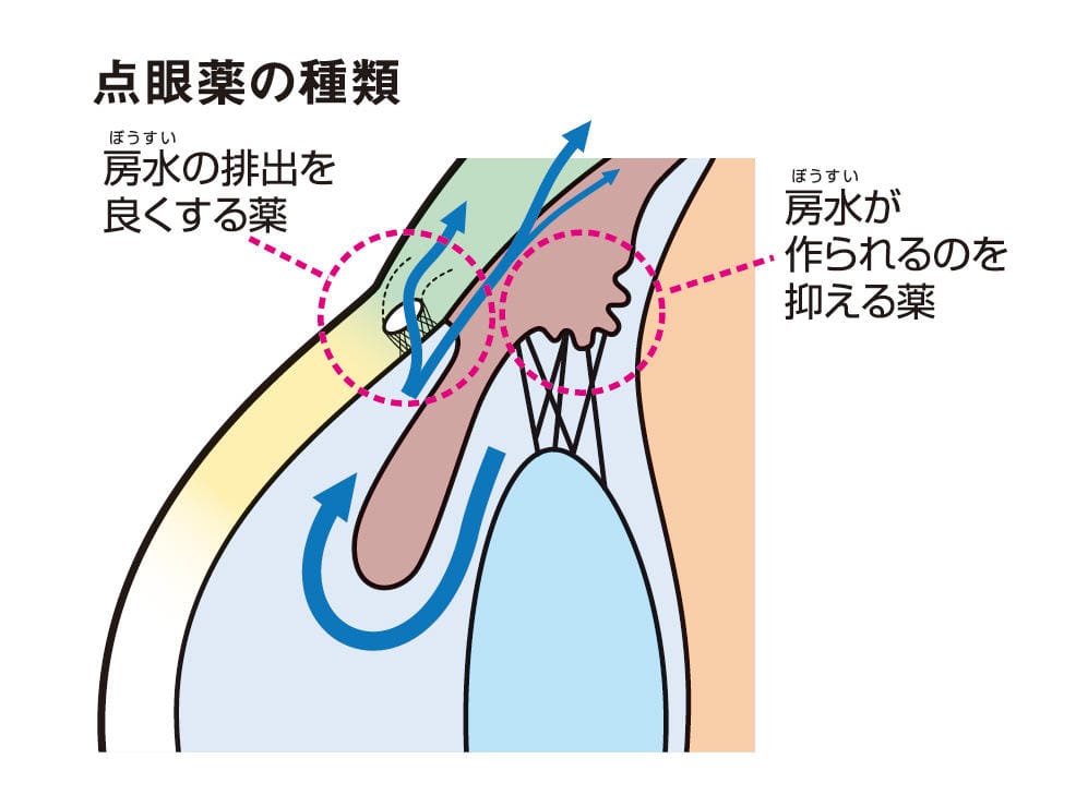 眼圧が高い状態