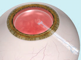 眼内コンタクトレンズ（ICL）手術方法
