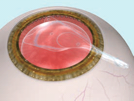 眼内コンタクトレンズ（ICL）手術方法