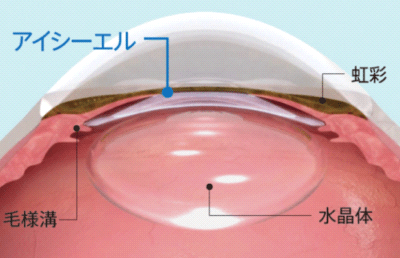 眼内コンタクトレンズ（ICL）手術方法