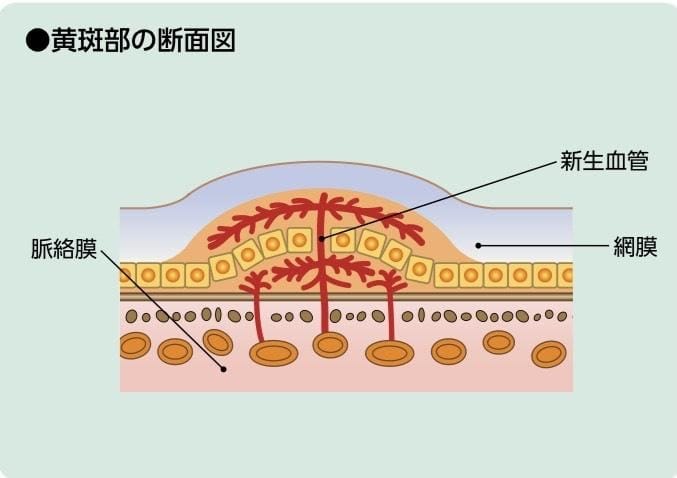 加齢黄斑変性症