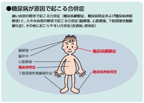 糖尿病網膜症に伴う黄斑浮腫