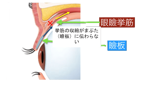 挙筋腱膜縫着術（小切開法）