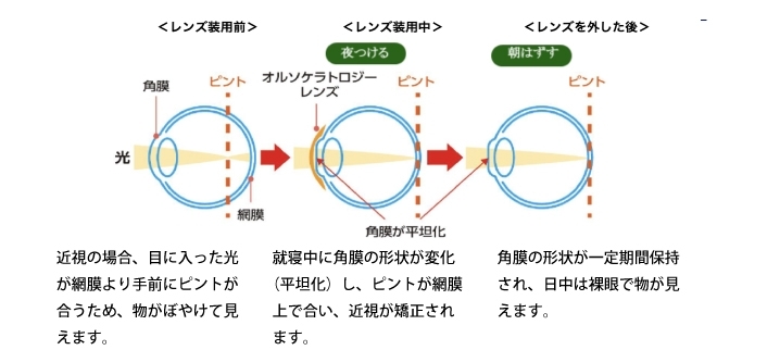 オルソケラトロジーの仕組み