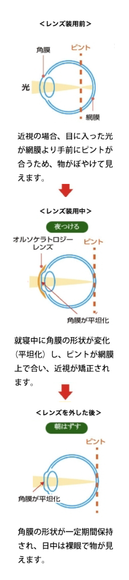 オルソケラトロジーの仕組み