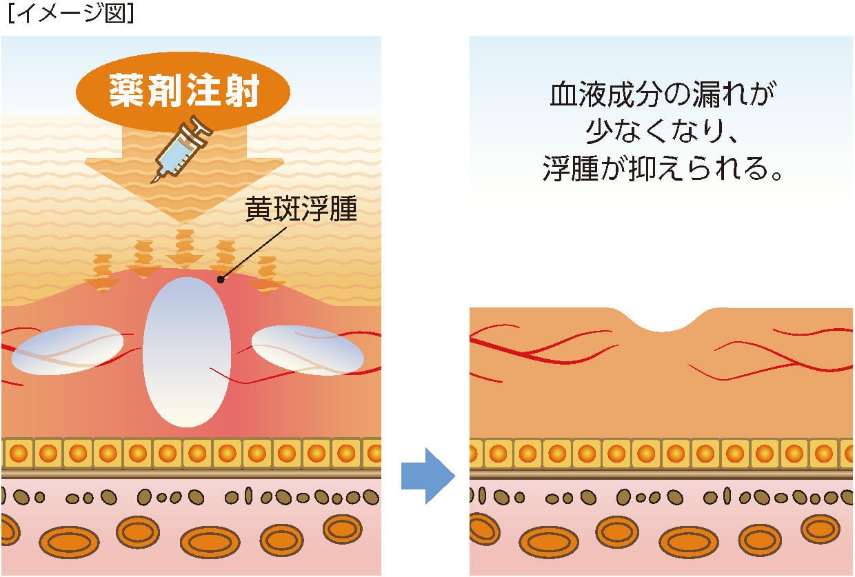 網膜の治療