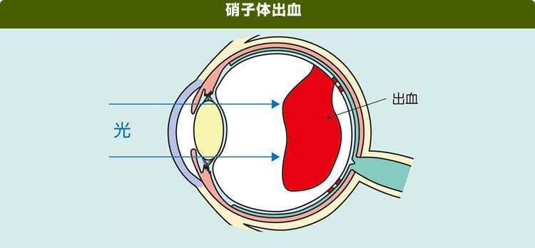 網膜の治療