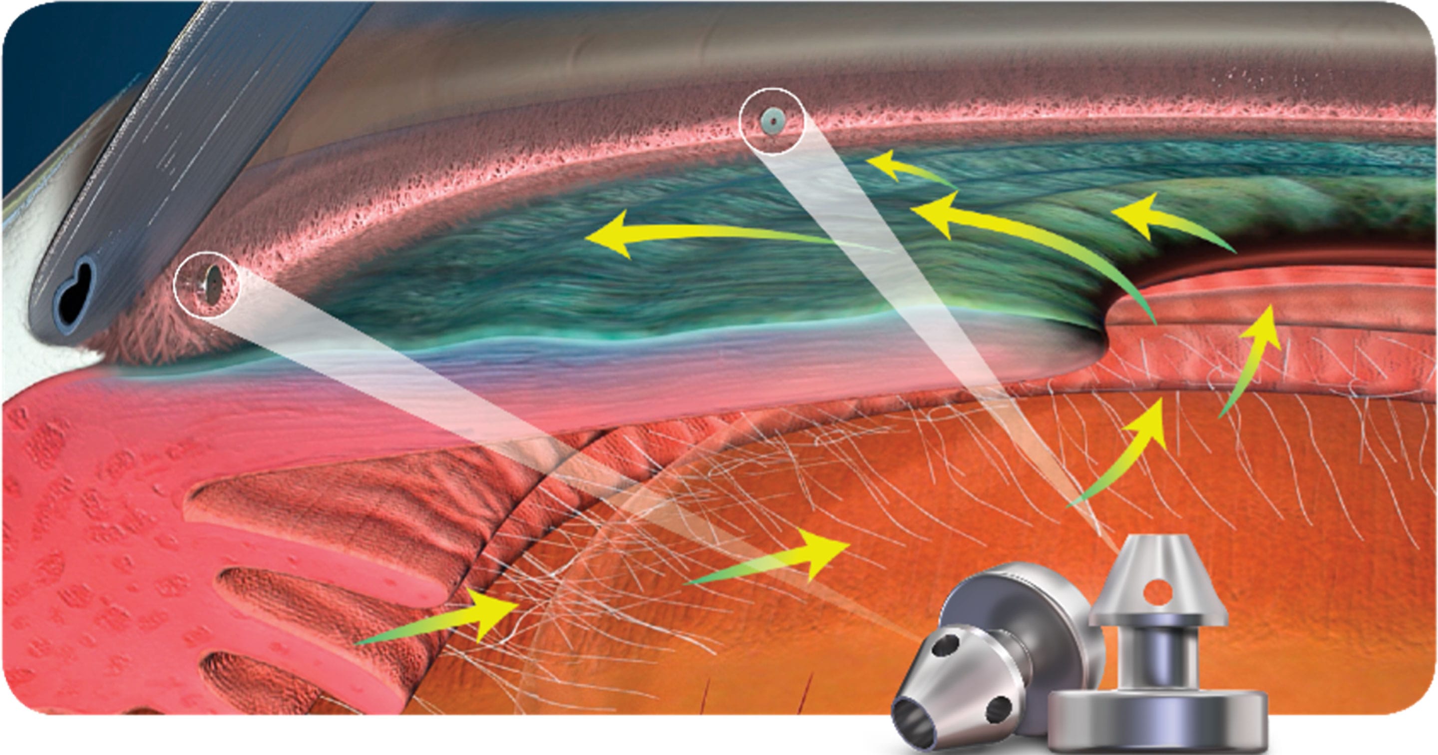 水晶体再建術併用眼内ドレーン手術