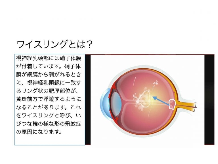 手術をしない飛蚊症治療ビトレオライシスとは？